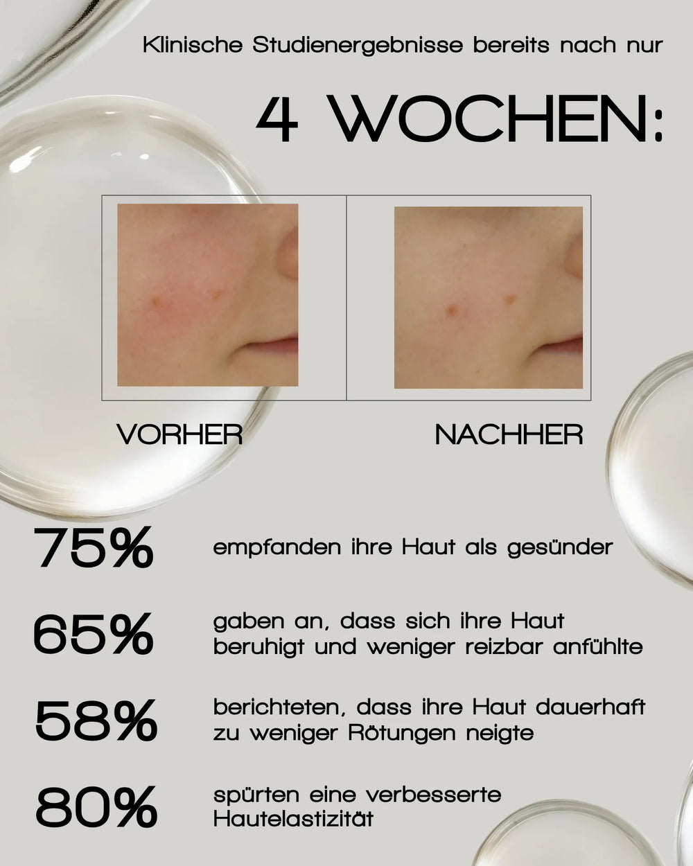 Nahaufnahmen vor und nach der Anwendung zeigen eine Verbesserung der Haut mit einer Flasche MERME Berlin MORE MOISTURE FACE SERUM. Der Text zeigt die Ergebnisse nach 4 Wochen: gesündere Haut, weniger Irritationen, reduzierte Rötungen und verbesserte Elastizität.