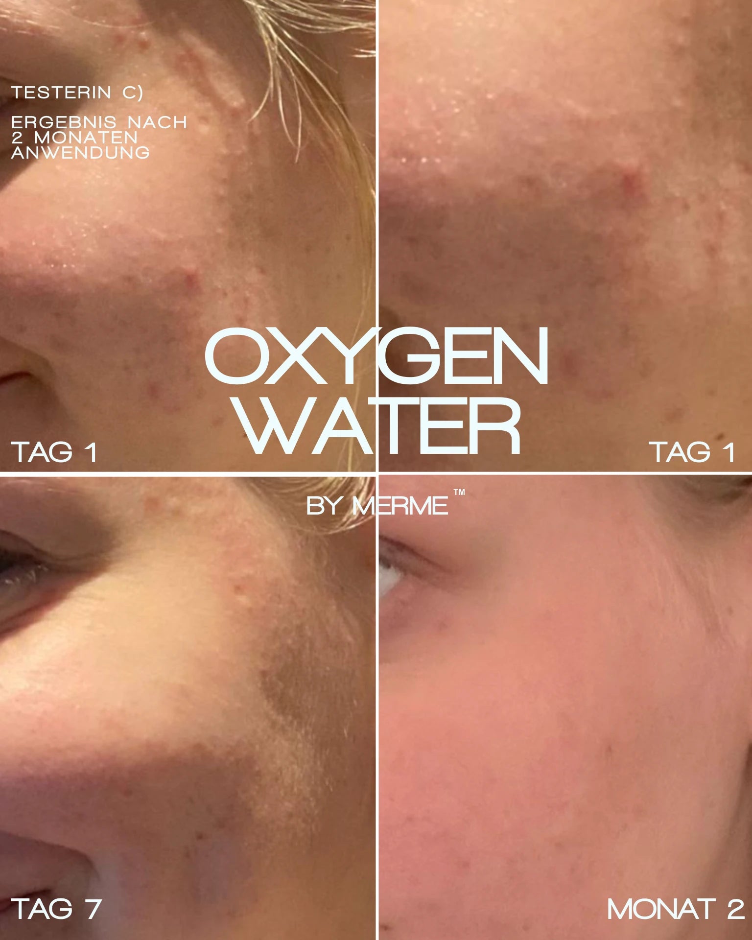 Die Collage zeigt den 2-monatigen Hautfortschritt mit dem OXYGEN WATER BY MERME 4-WOCHEN-SET von MERME Berlin. Vier Schnitte zeigen weniger Hautunreinheiten, glattere Haut und die Sauerstoff-Microbubble-Technologie. Der Text ist in Deutsch und Englisch.