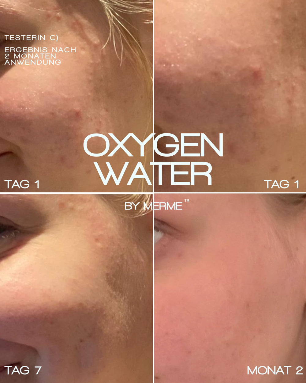 Die Collage zeigt den 2-monatigen Hautfortschritt mit dem OXYGEN WATER BY MERME 4-WOCHEN-SET von MERME Berlin. Vier Schnitte zeigen weniger Hautunreinheiten, glattere Haut und die Sauerstoff-Microbubble-Technologie. Der Text ist in Deutsch und Englisch.