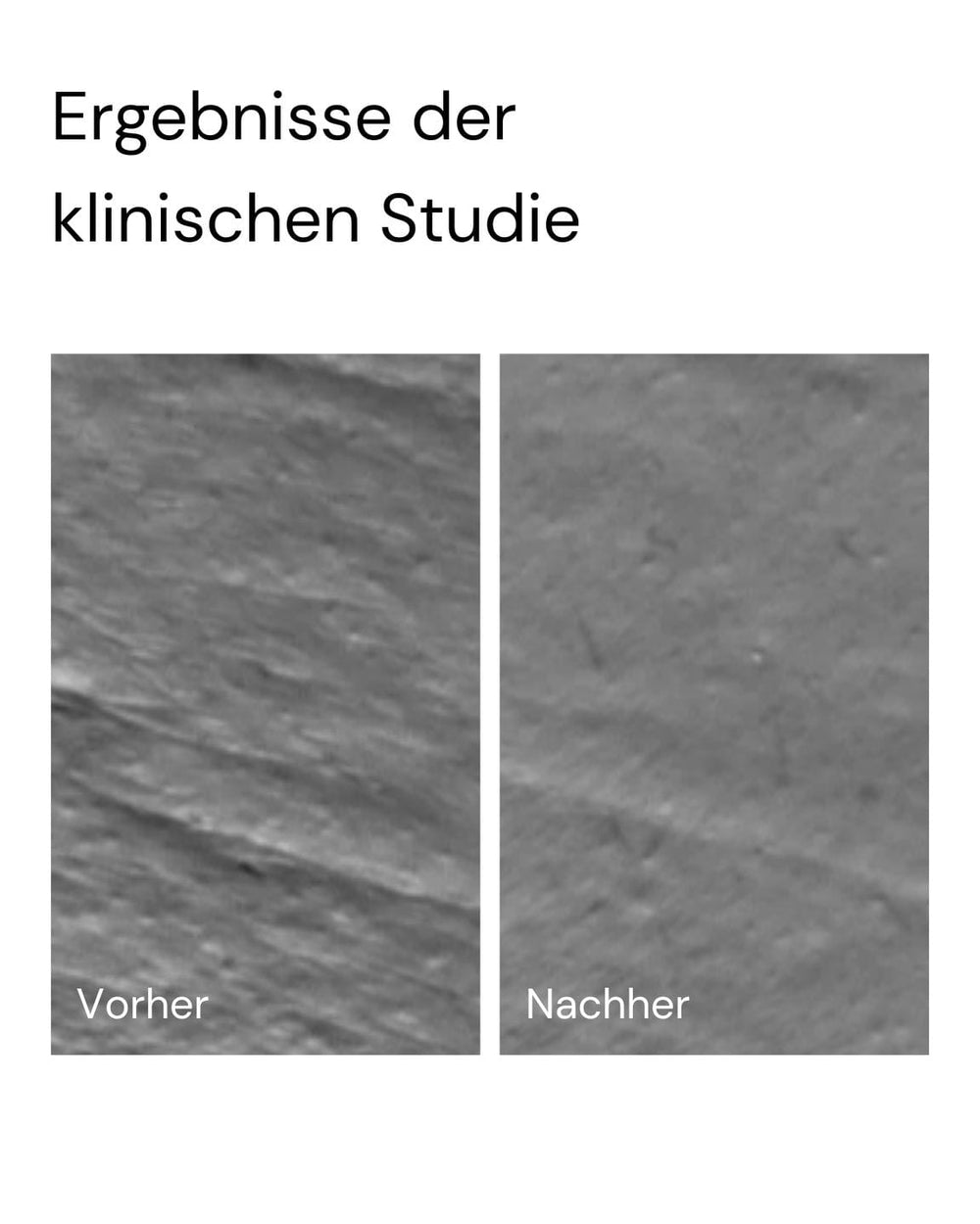 Zwei Graustufen-Nahaufnahmen vergleichen das Hautbild: "Vorher" zeigt Rauheit und Falten, "Nachher" glattere Haut nach Anwendung der MERME Berlin Milky Drops Face Moisturiser. Der deutsche Text darüber lautet "Ergebnisse der klinischen Studie.