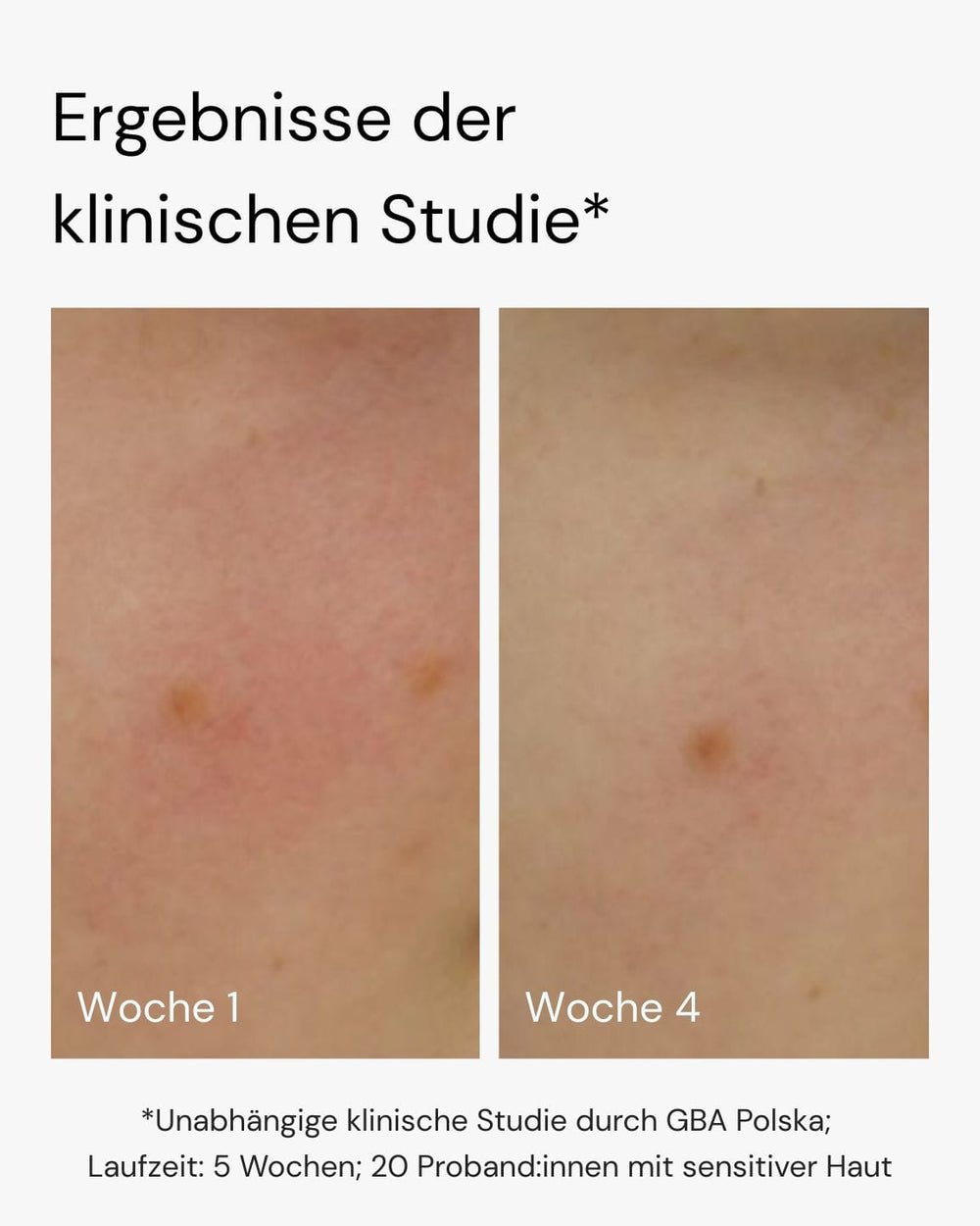 Nebeneinander liegende Nahaufnahmen der Haut, beschriftet mit "Woche 1" und "Woche 4", zeigen die Verringerung von Rötungen und Unreinheiten nach der Anwendung von MERME Berlin More Moisture Face Serum. Der deutsche Text beschreibt eine klinische Studie an empfindlicher Haut.