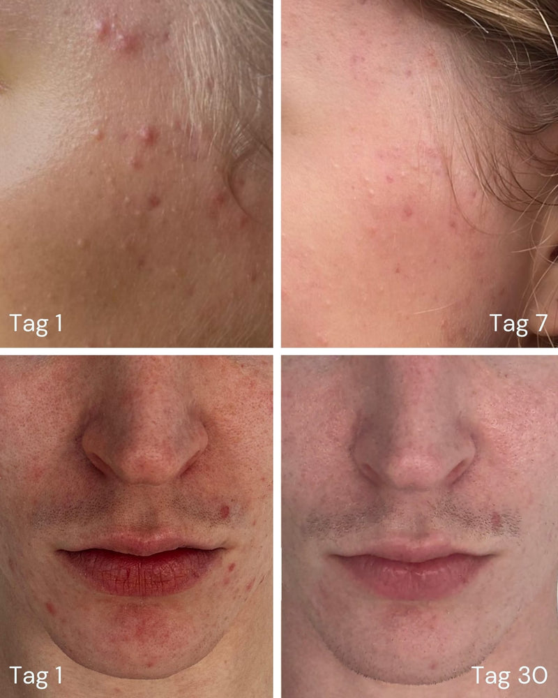 Eine Collage aus vier Nahaufnahmen zeigt die Abheilung von Akne von Tag 1 bis Tag 30 - die Haut wird klarer mit der OXYGEN WATER PORE CLEARING SOLUTION - 4 WOCHEN von MERME Berlin, powered by Sauerstoff-Microbubble-Technologie.