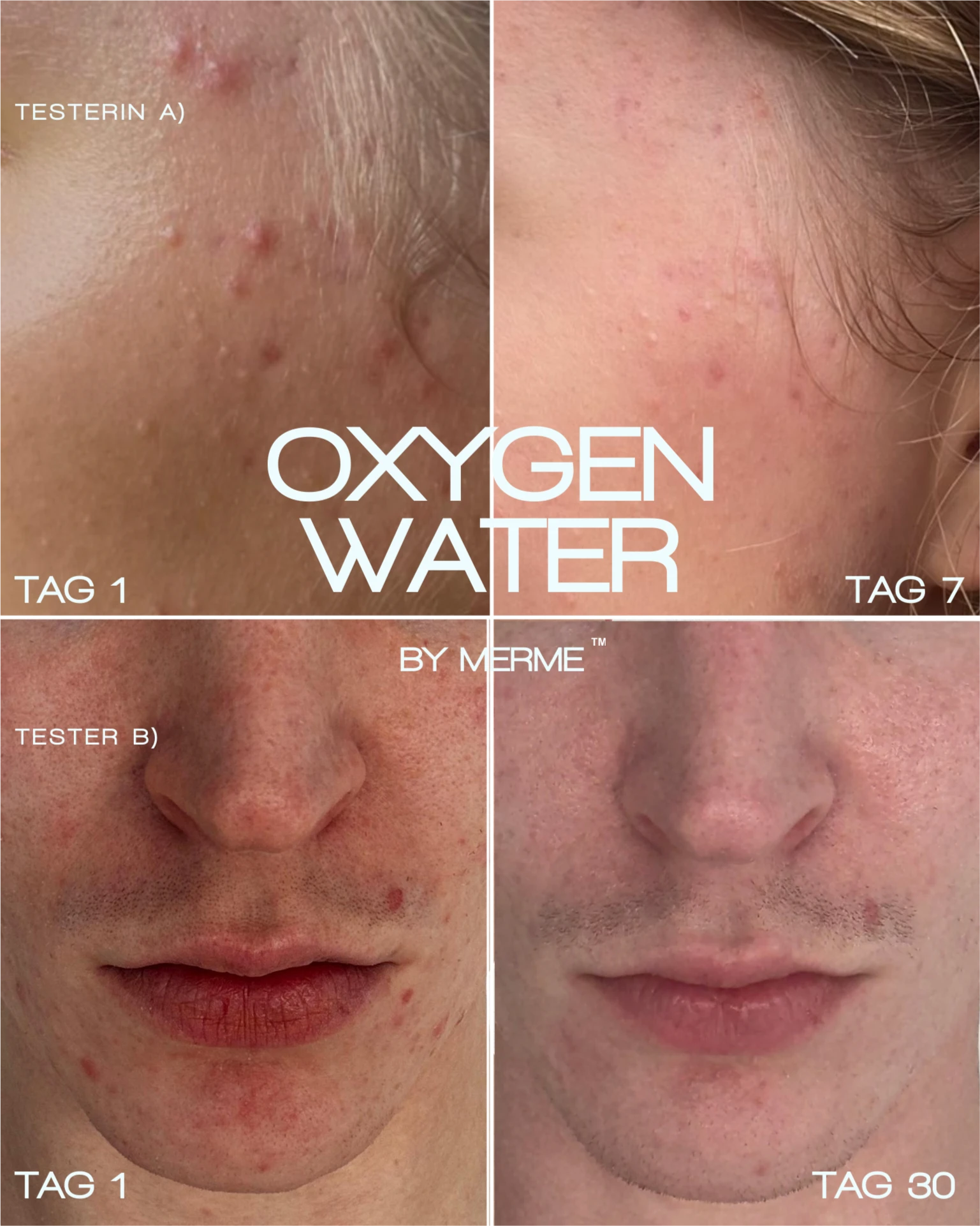Nahaufnahmen der Testerinnen A und B zeigen die Verbesserung der Haut von Akne und Rötungen an Tag 1 bis zu einer klareren Haut an Tag 30, mit dem "OXYGEN WATER BY MERME 4-WOCHEN-SET" von MERME Berlin und Sauerstoff-Microbubble-Technologie in der Mitte.